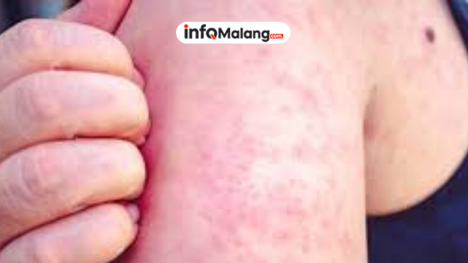 Pemkot Malang Ajak Masyarakat Cegah Campak Mulai dari Sekarang