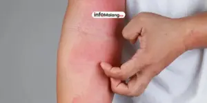 Apa itu Eksim? Gejala, Penyebab, dan Cara Mengatasinya