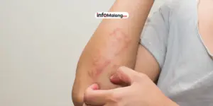 Berbagai Jenis Gatal dan Tips Mengurangi Rasa Tidak Nyaman