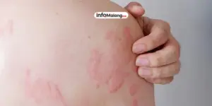 Biduran pengertian penyebab cara pengobatan dan larangan, informasi untuk menjaga kesehatan kulit