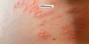 Cacar Air Penjelasan Gejala Penyebab dan Penanganan Medis