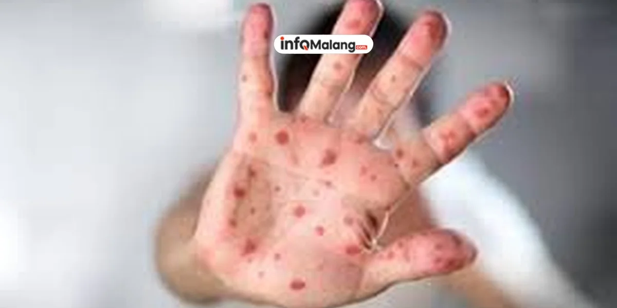 Kasus Campak di Kota Malang Turun Drastis, Dinkes Pastikan Situasi Terkendali