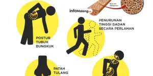 Osteoporosis Faktor Risiko, Gejala, dan Cara Menjaga Tulang Tetap Kuat
