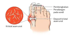 Pengertian Asam Urat Penyebab Gejala Cara Pengobatan dan Pantangan yang Harus Diketahui