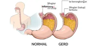 Penyakit Maag Gejala, Pemicu, dan Pola Makan yang Dianjurkan