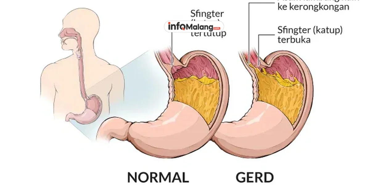 Penyakit Maag Gejala, Pemicu, dan Pola Makan yang Dianjurkan