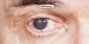 Penyebab Katarak dan Cara Mencegahnya: Waspadai Sejak Dini