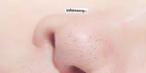 Penyebab Komedo di Wajah serta Tips Ampuh Mencegahnya