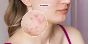 Remaja Rentan Alami Masalah Kulit Akibat Penggunaan Produk Kosmetik Tidak Sesuai