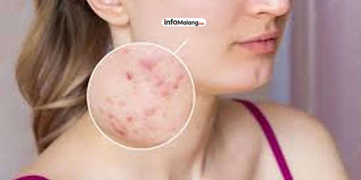 Remaja Rentan Alami Masalah Kulit Akibat Penggunaan Produk Kosmetik Tidak Sesuai