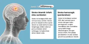 Stroke Penjelasan Penyebab Cara Pengobatan dan Larangan yang Harus Diketahui