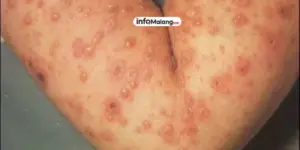 Waspada Cacar Monyet di Malang, Begini Langkah Antisipasinya