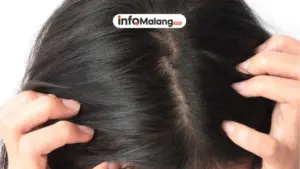Gatal Kepala Tak Kunjung Hilang Ini Penyebab Ketombe dan Cara Mengatasinya