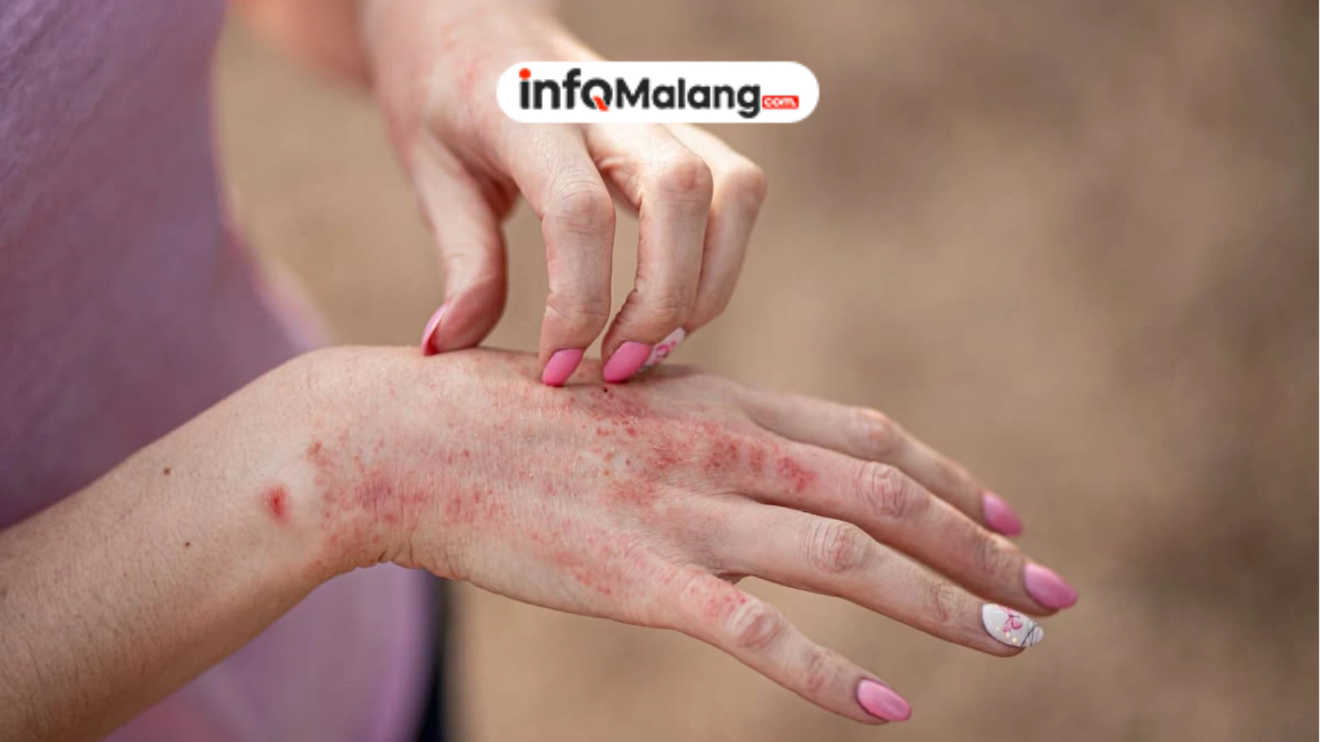 Dermatitis Bisa Menyerang Semua Usia, Kenali Penyebab dan Gejalanya
